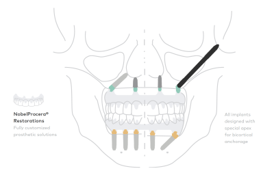 Làm răng Implant Zygomatic là gì?